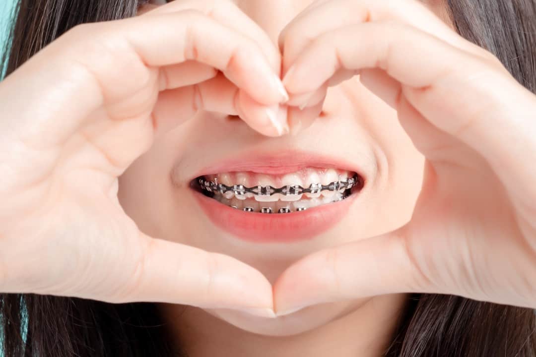 Things Not to Do With Braces